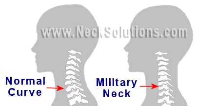 How do you deal with military neck?