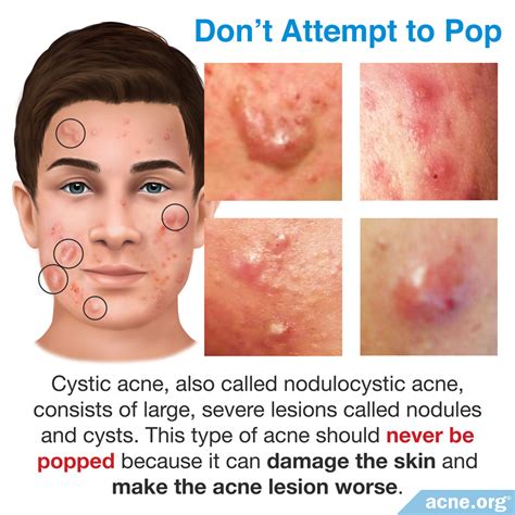 How do you deflate a cystic pimple?