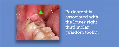 How do you eat with pericoronitis?