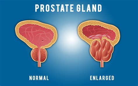 How do you find your prostate?