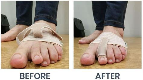 How do you fix a bent second toe?