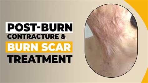 How do you fix a burn scar?