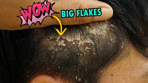 How do you fix a dirty scalp?