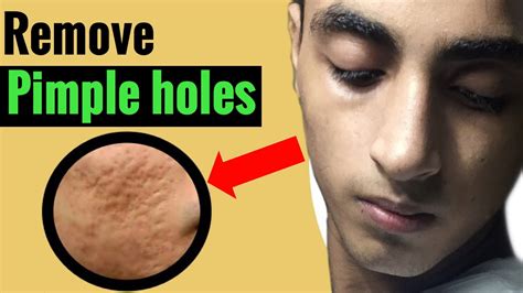 How do you fix a hole left in a pimple?