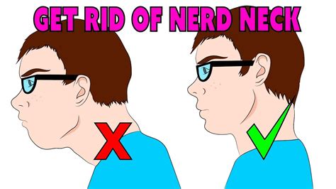 How do you fix a nerd neck posture?
