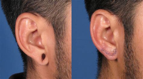 How do you fix a ripped earlobe without surgery?