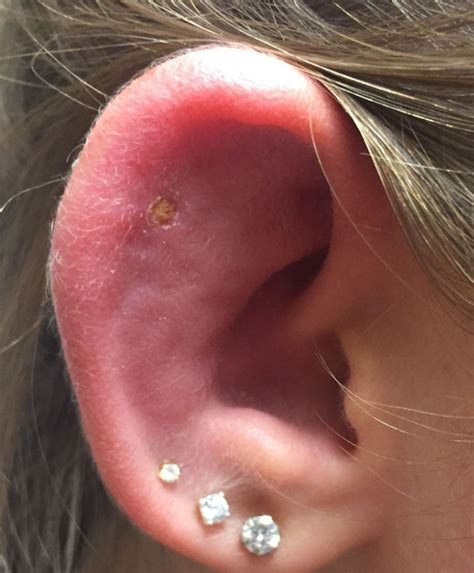 How do you fix a swollen ear piercing?