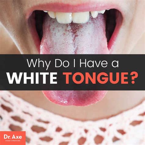 How do you fix a white tongue?