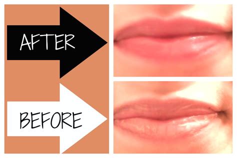 How do you fix chapped lips?