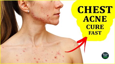 How do you fix chest acne?