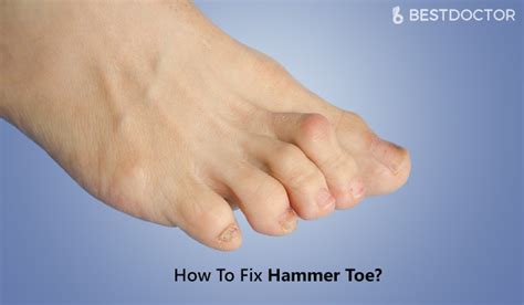 How do you fix curled toes without surgery?