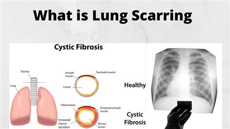 How do you fix lung scarring?