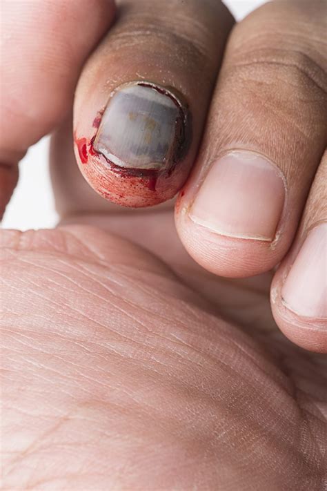 How do you fix nail trauma?