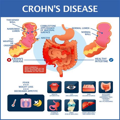 How do you get Crohn's?