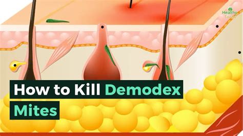 How do you get rid of Demodex mites fast?