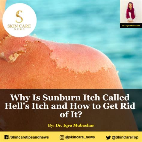 How do you get rid of Hell's itch sunburn?