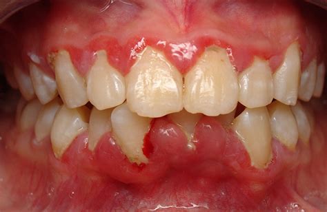 How do you get rid of a bacterial infection in your gums?