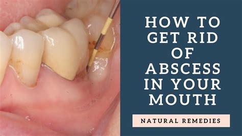 How do you get rid of a hard abscess on your gum?