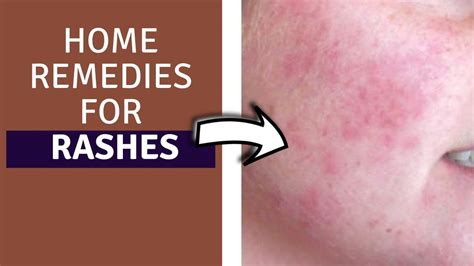 How do you get rid of a rash in 24 hours?