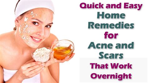 How do you get rid of acne in 3 days naturally?
