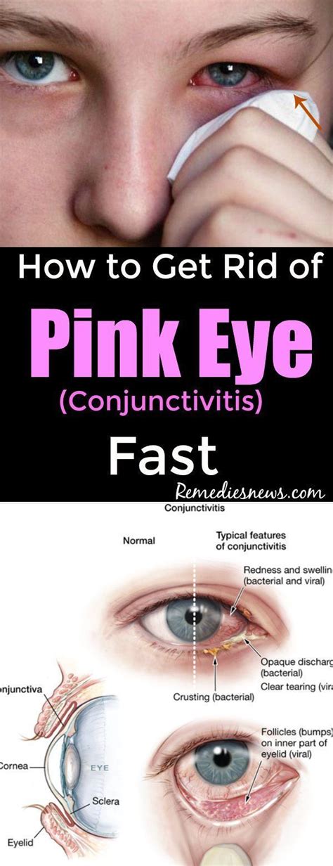 How do you get rid of bacterial eye?