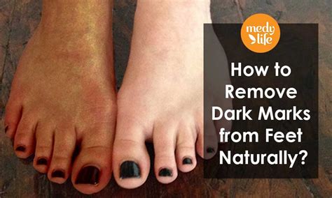 How do you get rid of black dirty feet?