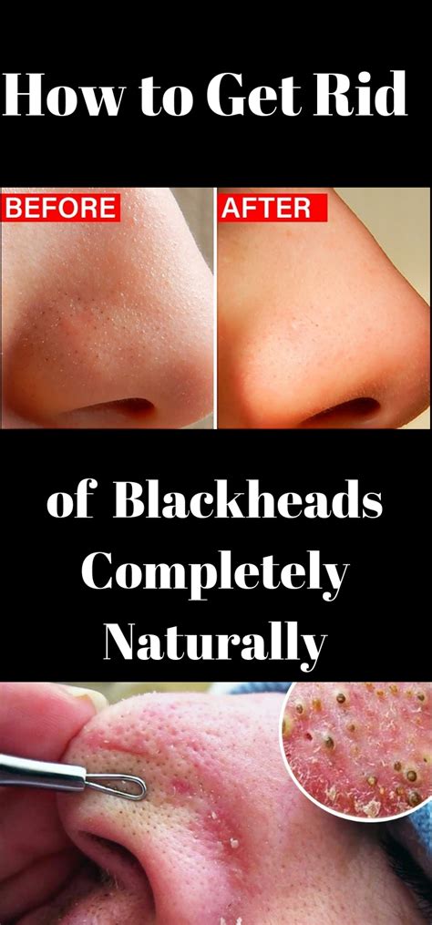 How do you get rid of blackheads overnight?