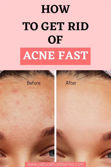 How do you get rid of body acne fast?