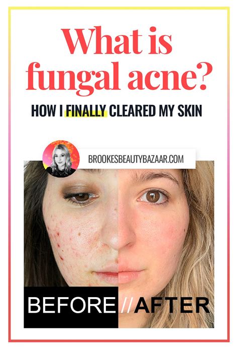 How do you get rid of fungal acne?