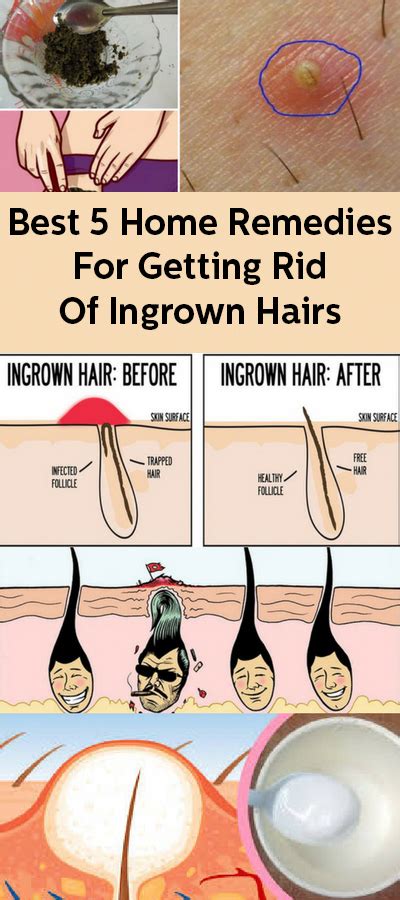 How do you get rid of ingrown pubic hairs overnight?