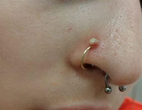 How do you get rid of pus ball on piercing?