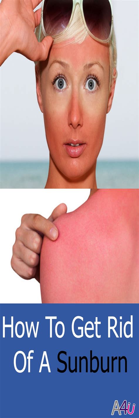 How do you get rid of red sunburn overnight?