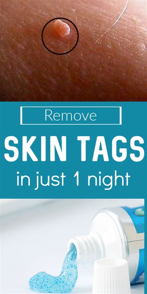 How do you get rid of skin tags in one night?