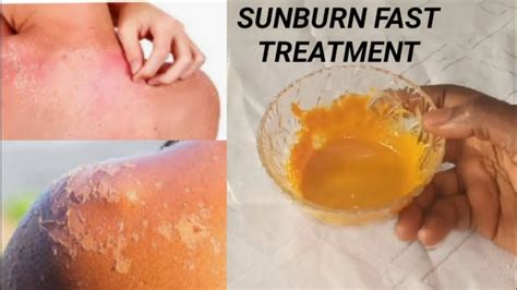 How do you get rid of sunburn fast?