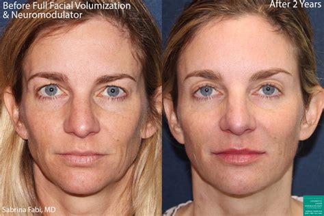 How do you get rid of sunken face naturally?