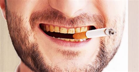 How do you get yellow teeth from smoking?