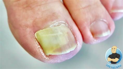How do you heal a lifted toenail?