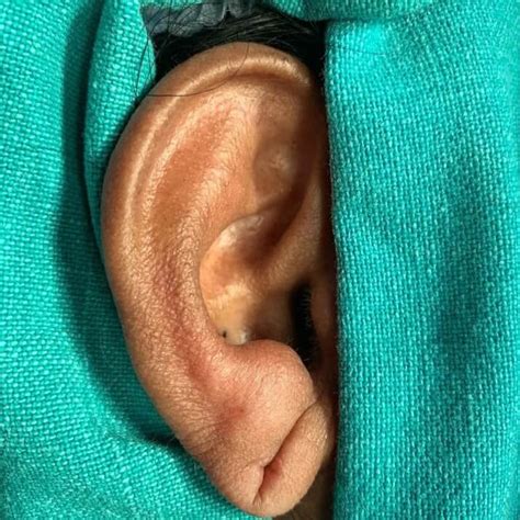 How do you heal a ripped ear hole?