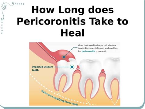 How do you heal pericoronitis fast?