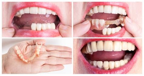 How do you hold false teeth in place?