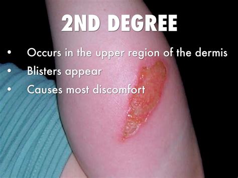 How do you identify a second-degree burn?