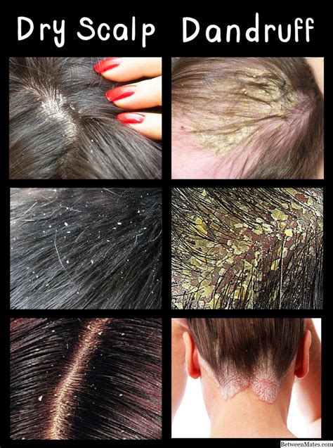 How do you identify dry hair?