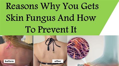 How do you keep fungus alive?