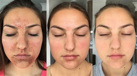 How do you keep your skin clear on Accutane?