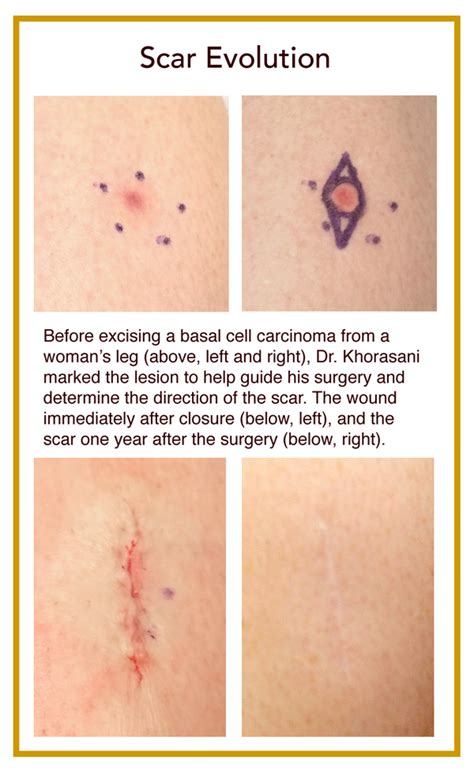 How do you know if a scar is permanent?