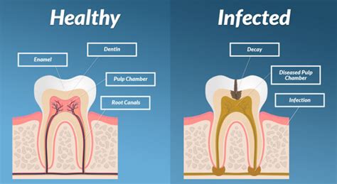 How do you know if a tooth infection is spread to the brain?