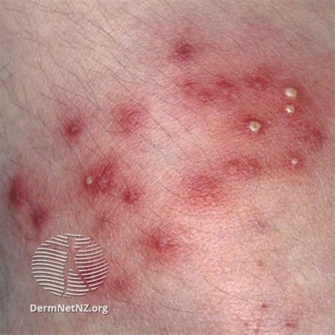 How do you know if folliculitis is bacterial?