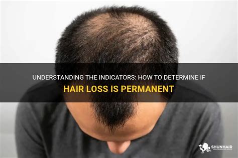 How do you know if hair loss is permanent?