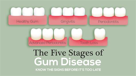 How do you know if periodontitis is advanced?