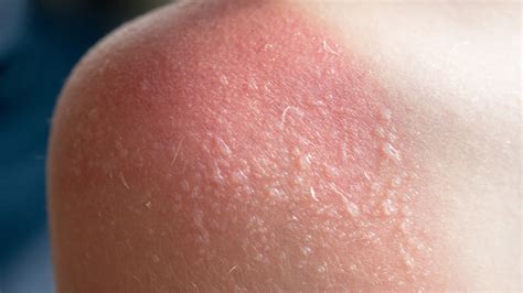 How do you know if you have 2nd degree sunburn?